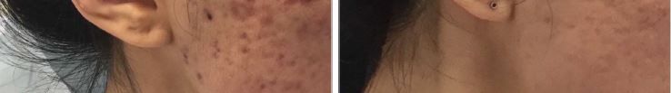 Acne Scaring PRF
